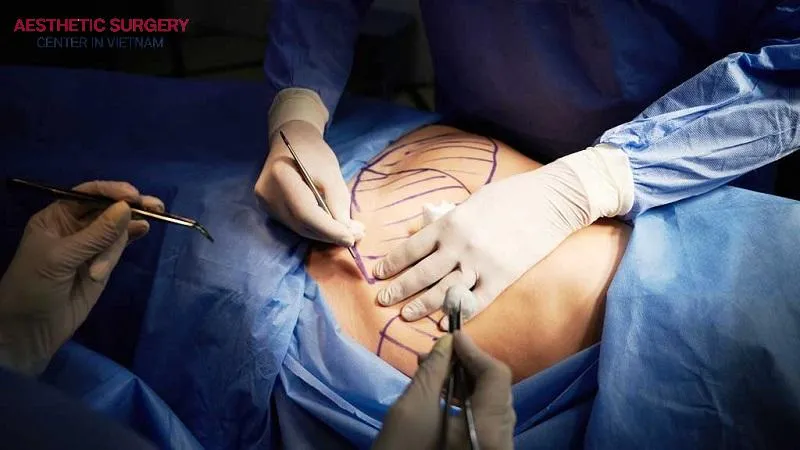 Abdominal liposuction is a complex technique but delivers fast and highly effective results.