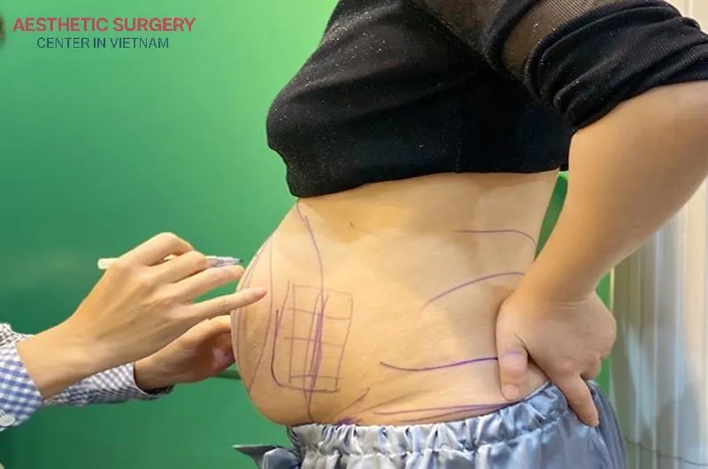 The ideal candidates for abdominal liposuction are typically between 20 and 50 years old.