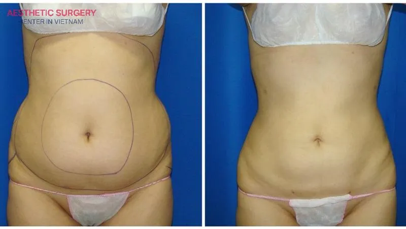 Abdominal liposuction helps restore a firm, slim waist, enhancing appearance and boosting the client’s confidence.