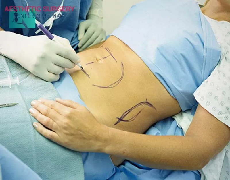 The surgeon marks the areas before performing liposuction to ensure precise and safe fat removal.