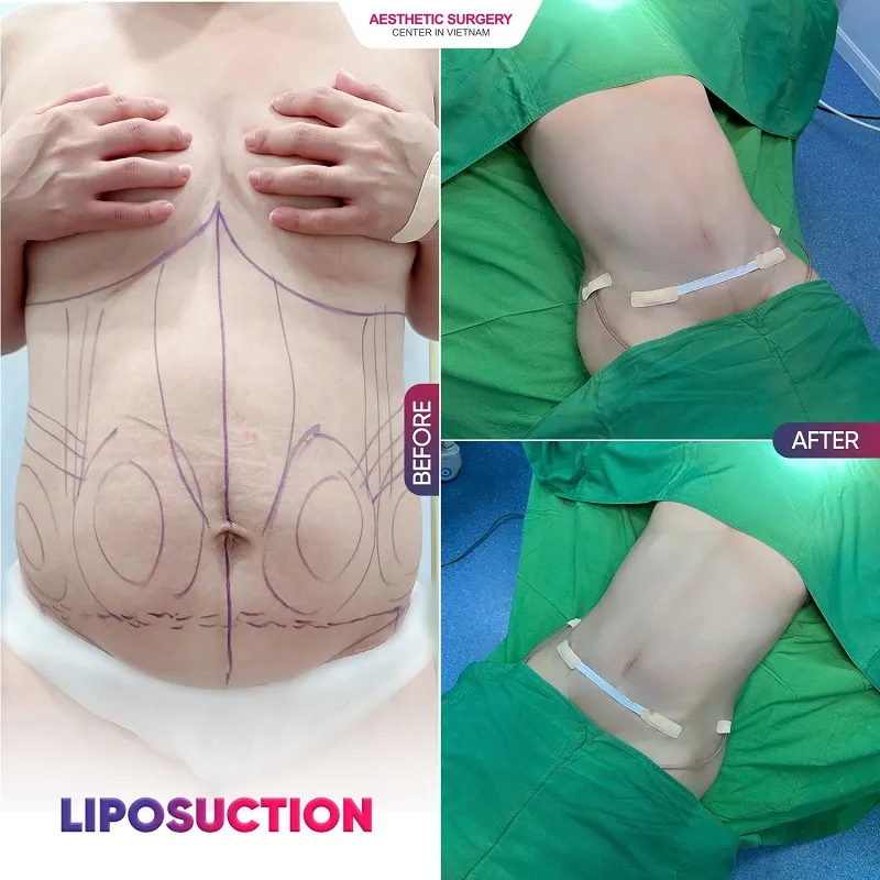 The client’s dream waistline became a reality after undergoing abdominal liposuction at Aesthetic Surgery Center.