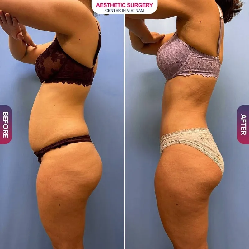 The client’s abdomen became slimmer and firmer, returning to the desired waist measurement after abdominal liposuction.