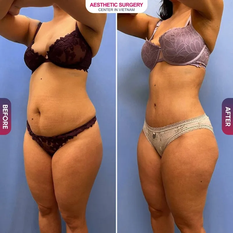 The abdominal area is flatter, firmer, and more toned after liposuction at Aesthetic Surgery Center.