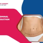 Abdominal Liposuction