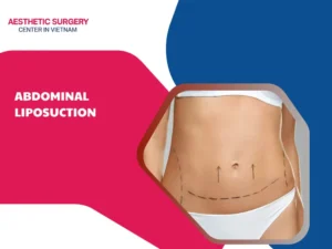 Abdominal Liposuction