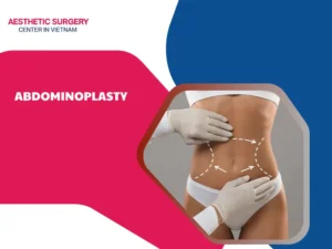 Abdominoplasty