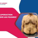 Can liposuction remove 100 pounds