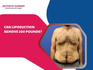Can liposuction remove 100 pounds