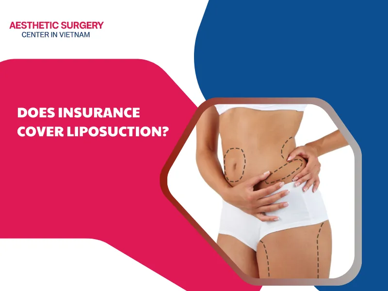 Does insurance cover liposuction