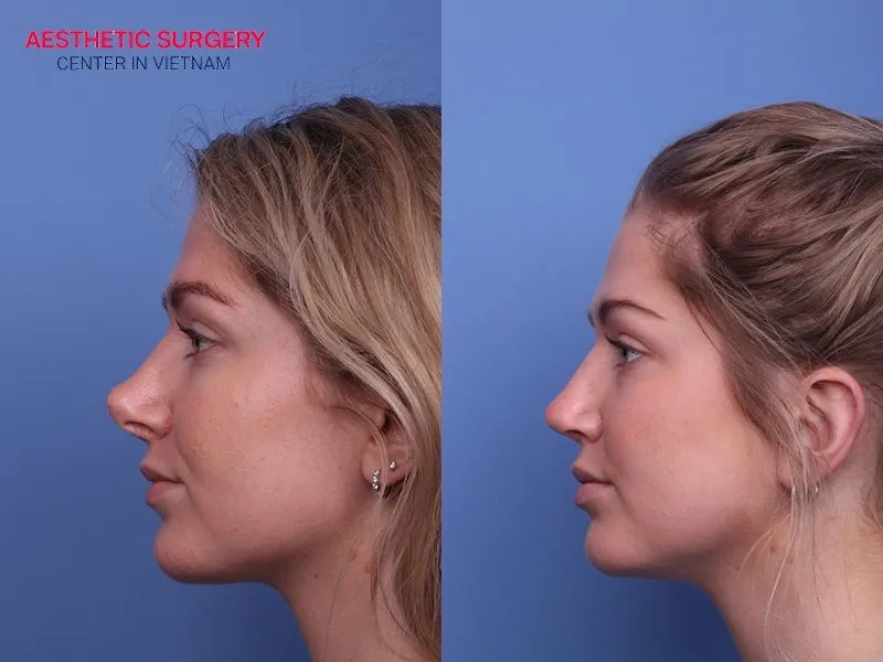 The cost of an ear cartilage rhinoplasty ranges from 1,000 to 3,000 USD.