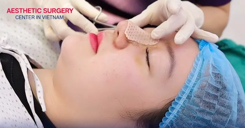 After 6–7 days, you can have the nasal splint removed.