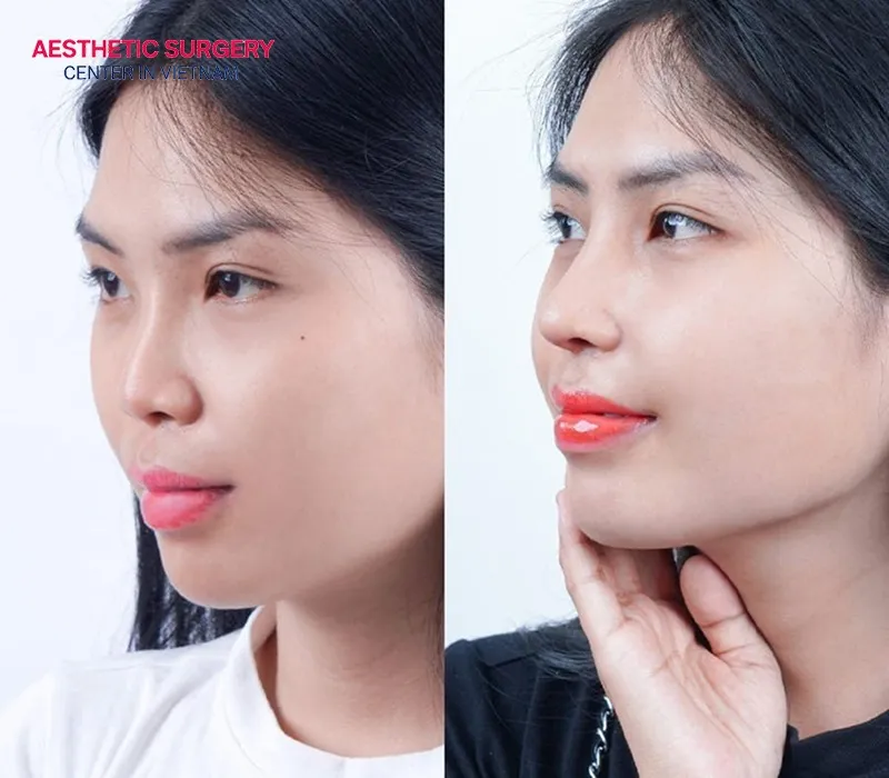 After surgery, you will have a higher, more refined nose.