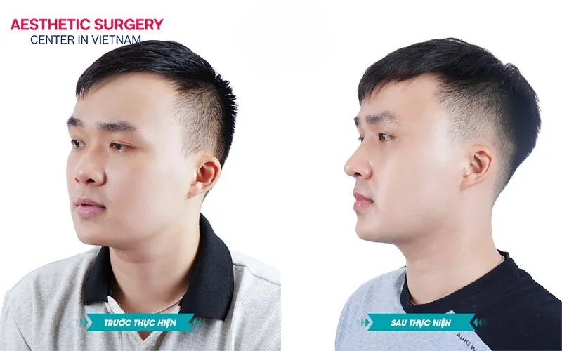 Your overall appearance will look younger with an improved nose shape.