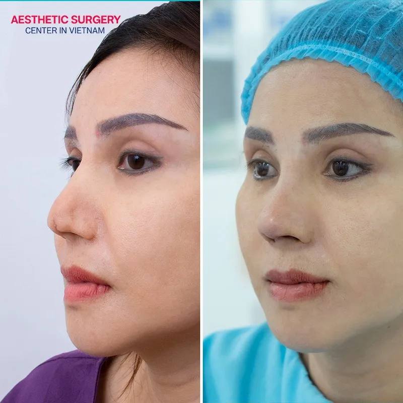 Results after Ear Cartilage Rhinoplasty