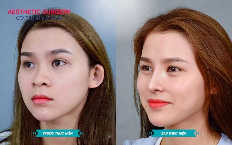 Your facial expression becomes more radiant after rhinoplasty.