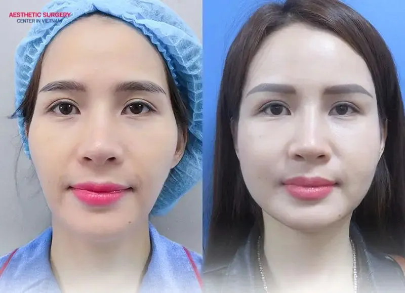 Facial fat grafting safely restores volume to sunken areas while rejuvenating the face with minimal invasiveness.