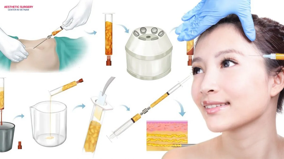 The facial fat grafting procedure is performed following strict medical safety standards.