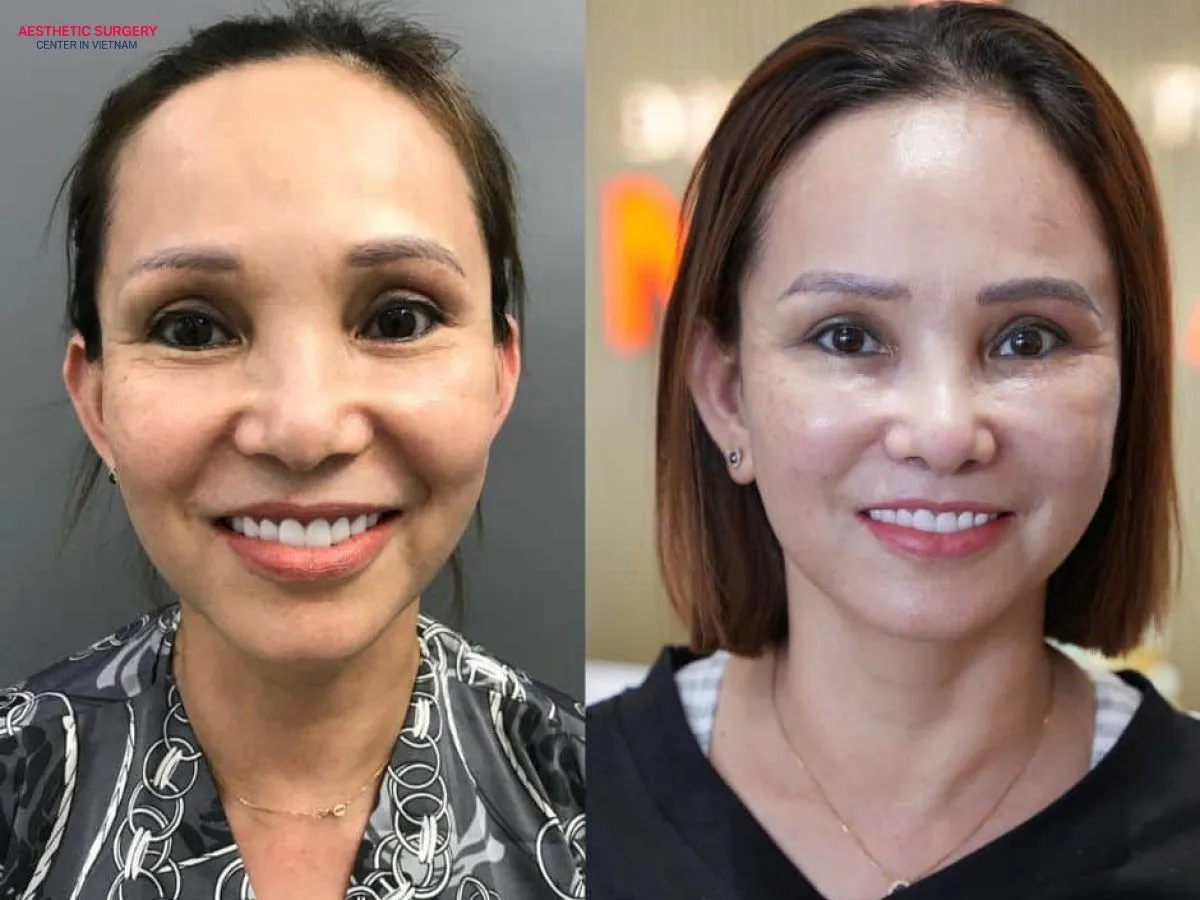 Facial fat grafting results can typically last from 1 to 2 years, or even longer if you have a favorable metabolism, take good care of your skin, and maintain a healthy lifestyle.