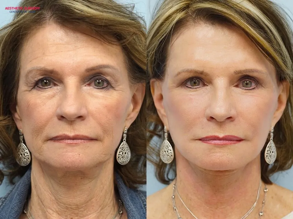 All wrinkles and hollow areas on the woman’s face have been naturally filled, enhancing her appearance noticeably.