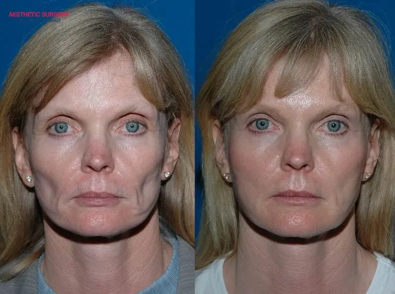 A remarkable transformation can be seen in the client’s face after undergoing facial fat grafting.
