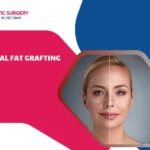 Facial Fat Grafting