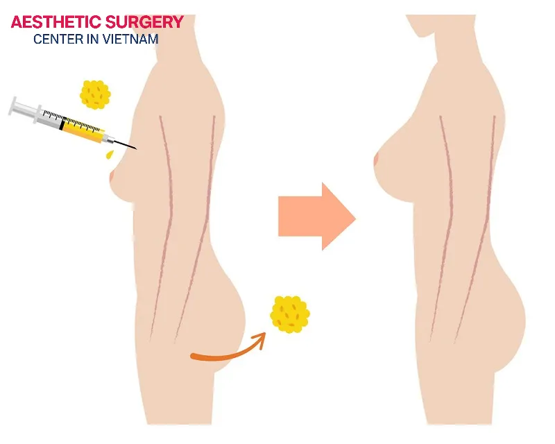 Fat transfer breast augmentation is a method that uses fat from your own body and transfers it to the breasts, helping them enlarge naturally.