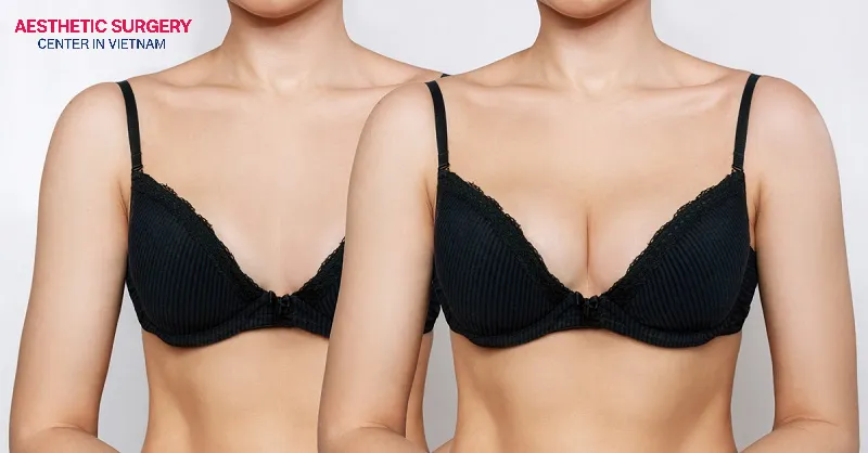 This non-surgical breast enhancement method helps the breasts increase in size naturally.