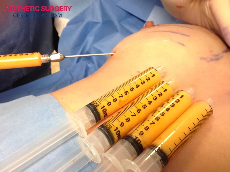 Fat transfer breast augmentation also has its disadvantages.