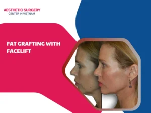 Fat grafting with facelift