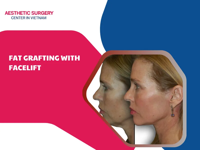 Fat grafting with facelift