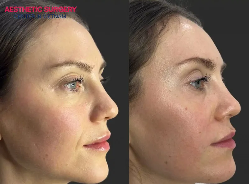 Smile lines will be naturally improved.