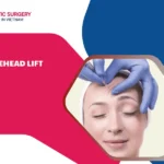 Forehead Lift