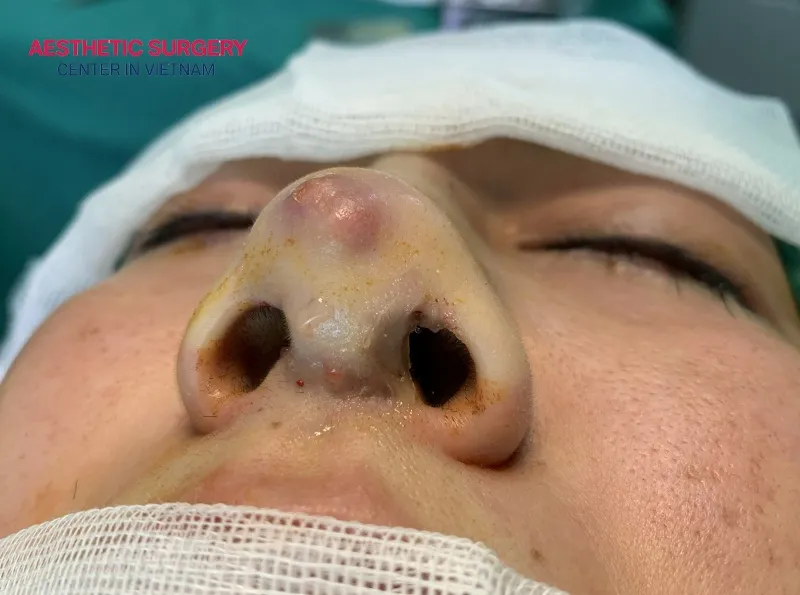 Revision rhinoplasty helps correct defects or complications from a previous nose surgery.