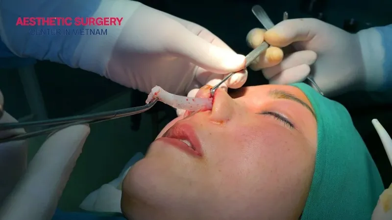 Revision Rhinoplasty Procedure