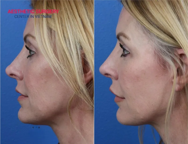 Revision rhinoplasty usually leaves very minimal scarring.