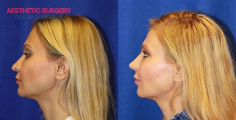 Rib cartilage rhinoplasty minimizes the risk of allergy, rejection, or implant visibility.