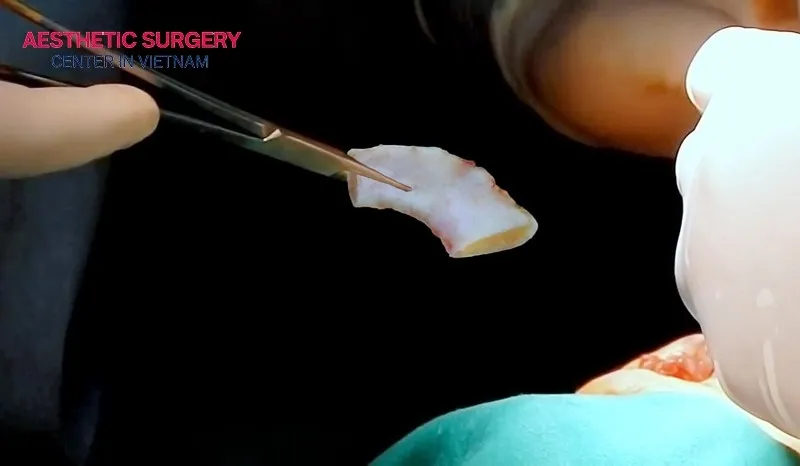 Autologous rib cartilage rhinoplasty in Vietnam ranges from 30 to 150 million VND.