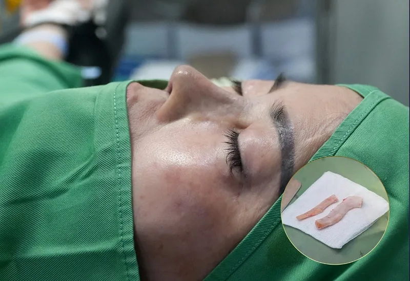 Autologous rib cartilage rhinoplasty procedure