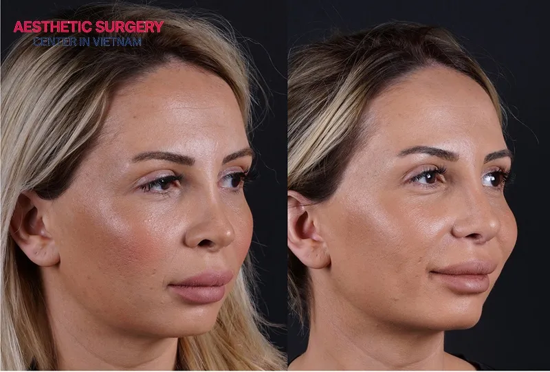 Full recovery is expected within 6 to 12 months.