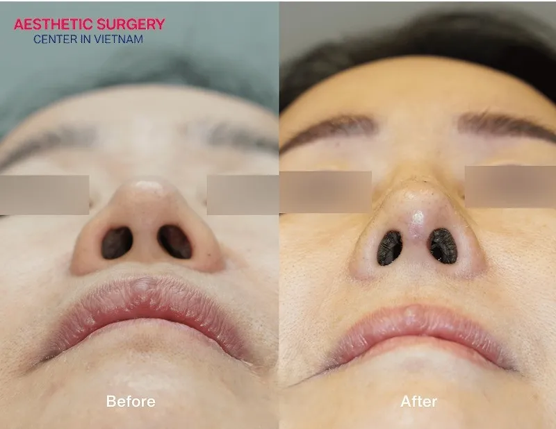 The shape of the nose changes noticeably after rhinoplasty.