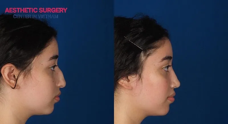 Rib cartilage rhinoplasty can correct a hooked nose shape.