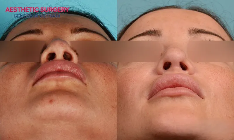 The nose becomes slimmer and more refined after surgery.