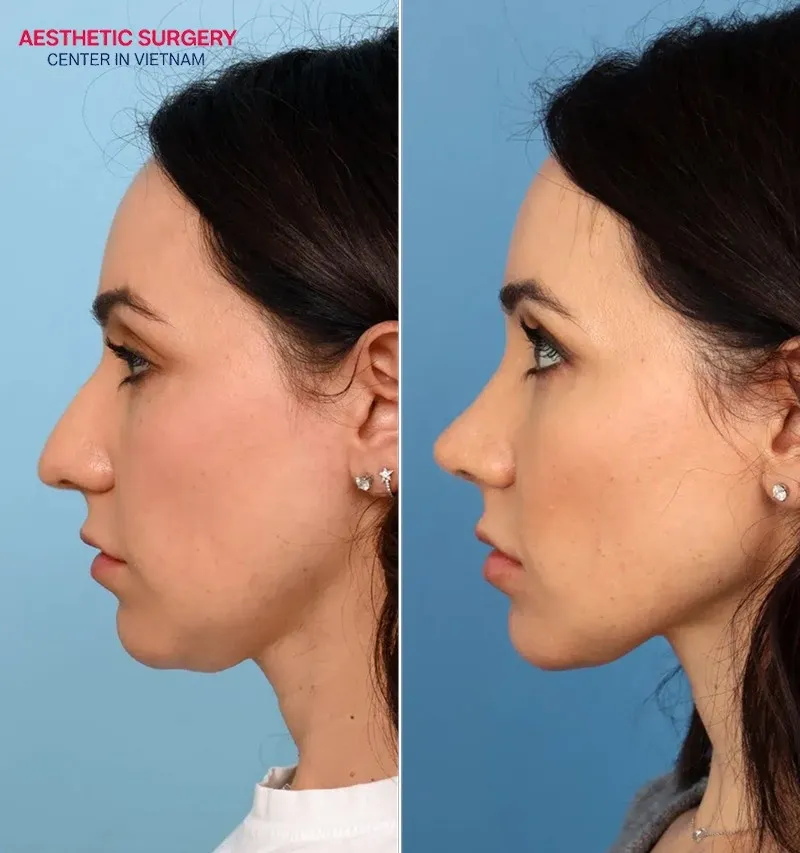 Achieve a perfect nose shape after rhinoplasty.