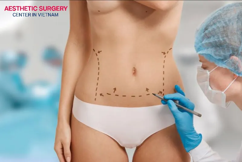 Abdominoplasty is a procedure that removes excess fat and tightens loose abdominal muscles, flattening the abdomen and creating a defined waistline.