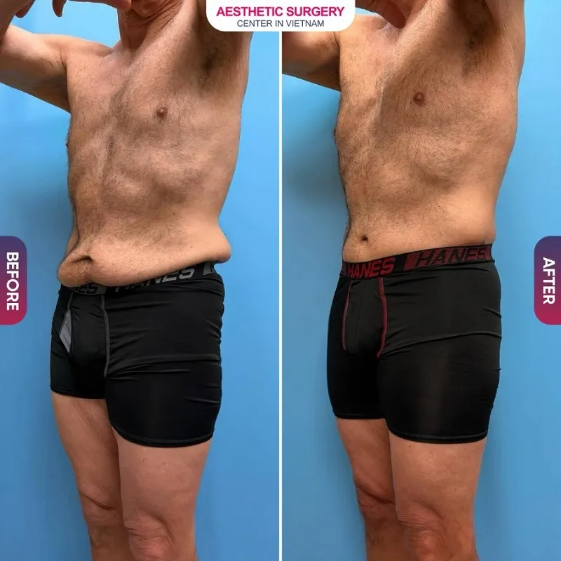 Before-and-after images of the male client following abdominoplasty.