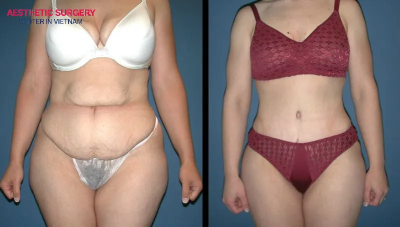 Abdominoplasty helps clients achieve the slim, sculpted waistline they desire.