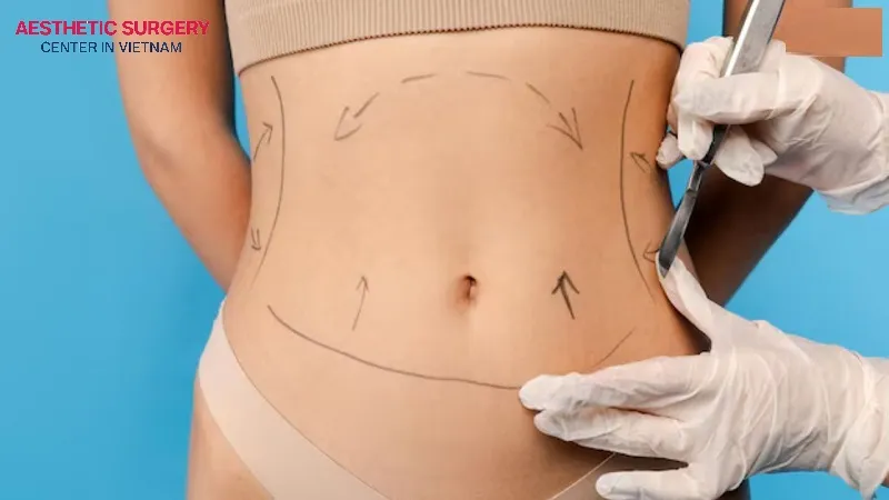 The surgeon marks the incision and treatment areas before performing abdominoplasty.