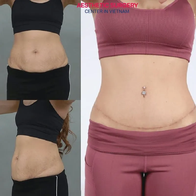 The remarkable transformation of clients’ waistlines after undergoing abdominoplasty at Aesthetic Surgery Center.
