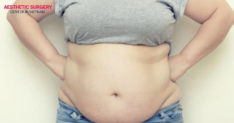 Individuals with an oversized waist who do not achieve results through strict diet and exercise may consider abdominoplasty.