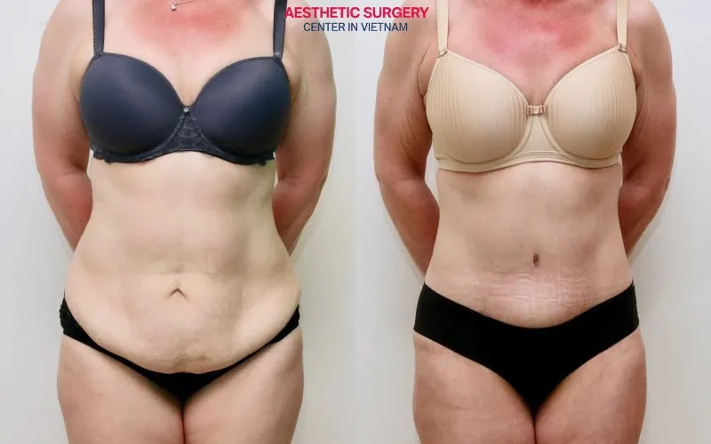 The client achieved a beautifully sculpted waistline as desired after abdominoplasty at Aesthetic Surgery Center.